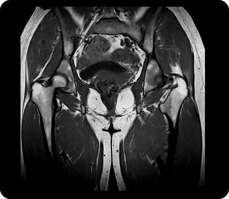 MRI of female pelvic organs