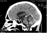 КТ головного мозга, черепа, области шеи