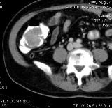 Abdomen and retroperitoneal space CT