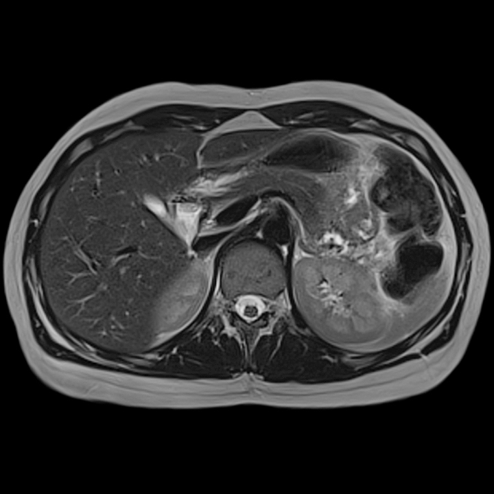 MRI of abdomen and retroperitoneal space